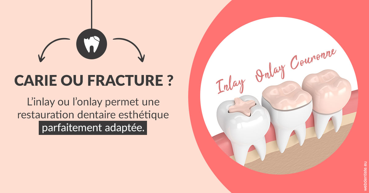 https://selarl-ms-dentaire.chirurgiens-dentistes.fr/T2 2023 - Carie ou fracture 2