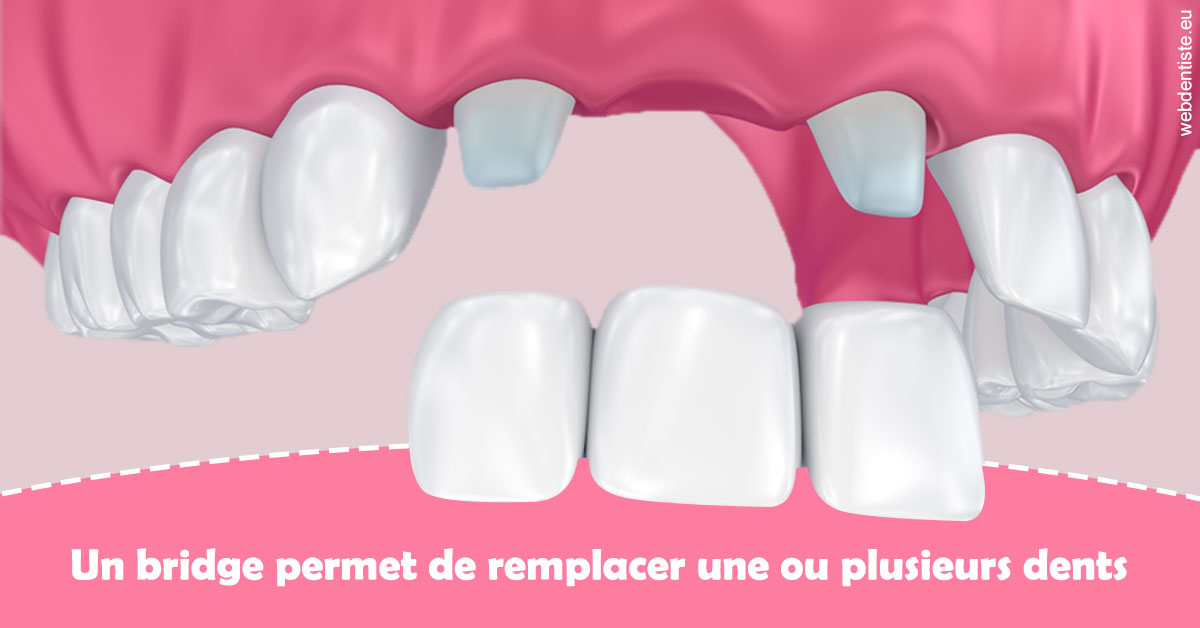 https://selarl-ms-dentaire.chirurgiens-dentistes.fr/Bridge remplacer dents 2