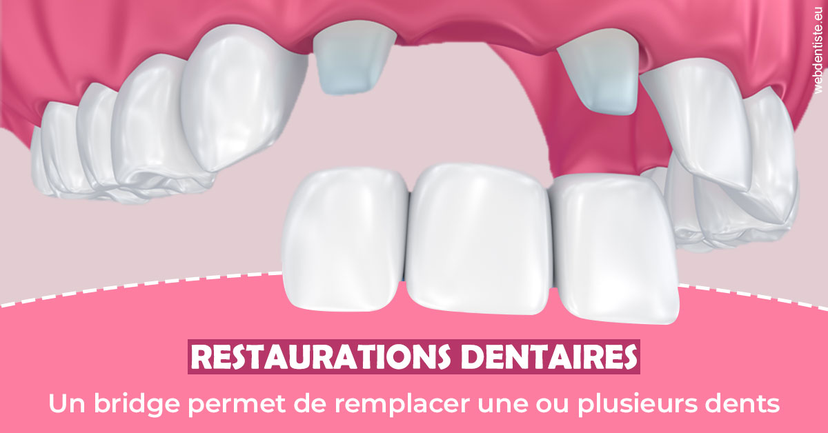 https://selarl-ms-dentaire.chirurgiens-dentistes.fr/Bridge remplacer dents 2