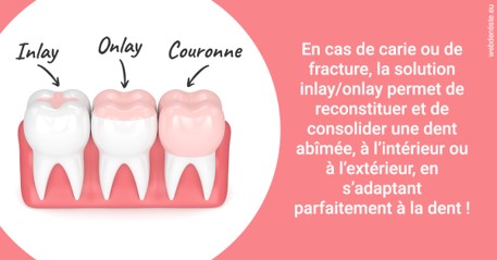 https://selarl-ms-dentaire.chirurgiens-dentistes.fr/L'INLAY ou l'ONLAY 2