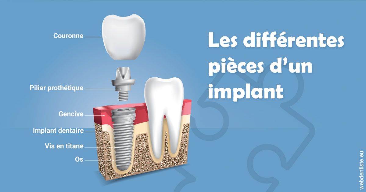 https://selarl-ms-dentaire.chirurgiens-dentistes.fr/Les différentes pièces d’un implant 1